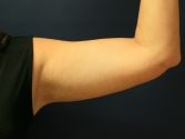 Feel Beautiful - Arm Liposuction plus Skin Tightening - After Photo